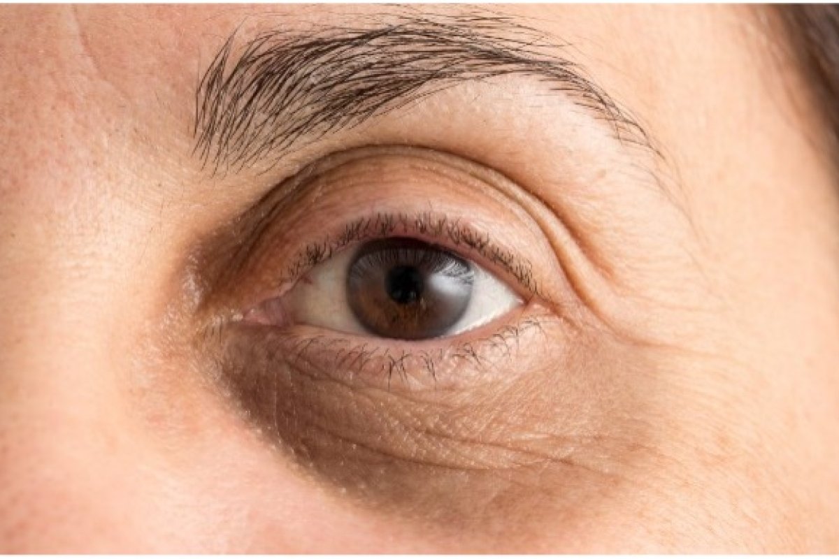 Dunkle Augenringe und Schwellungen unter den Augen