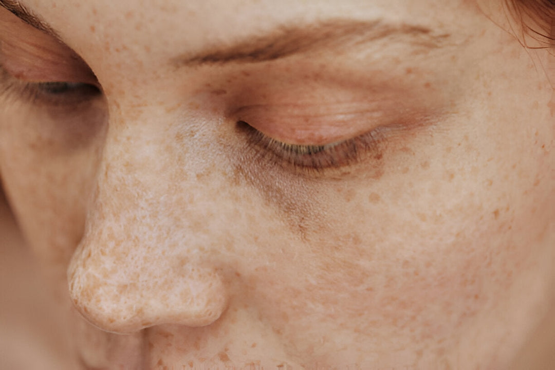 Pigmentierungen Hautpflege | Wonder Skin Deutschland