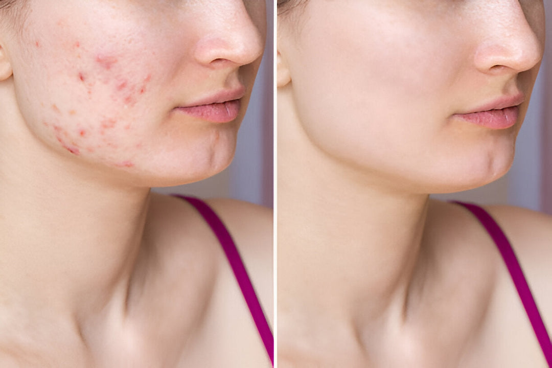 Akne Pflegeprodukte gegen Unreinheiten | Wonder Skin Deutschland
