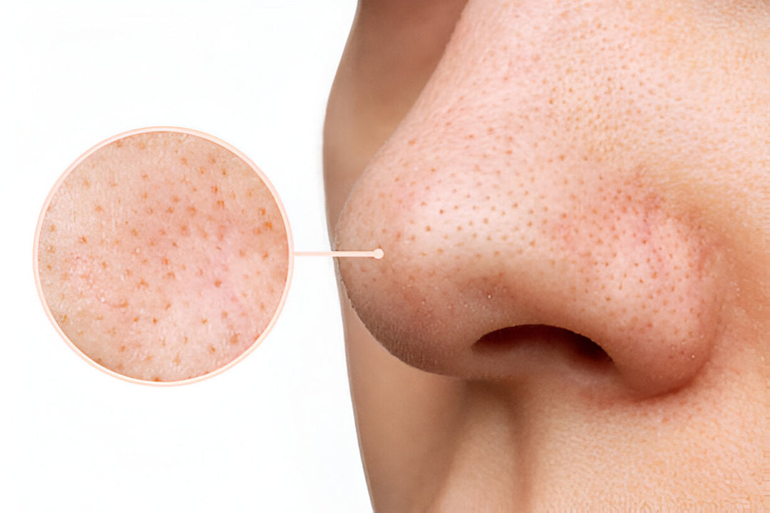 Große Poren Pflegeprodukte für Ihre Haut | Wonder Skin Deutschland