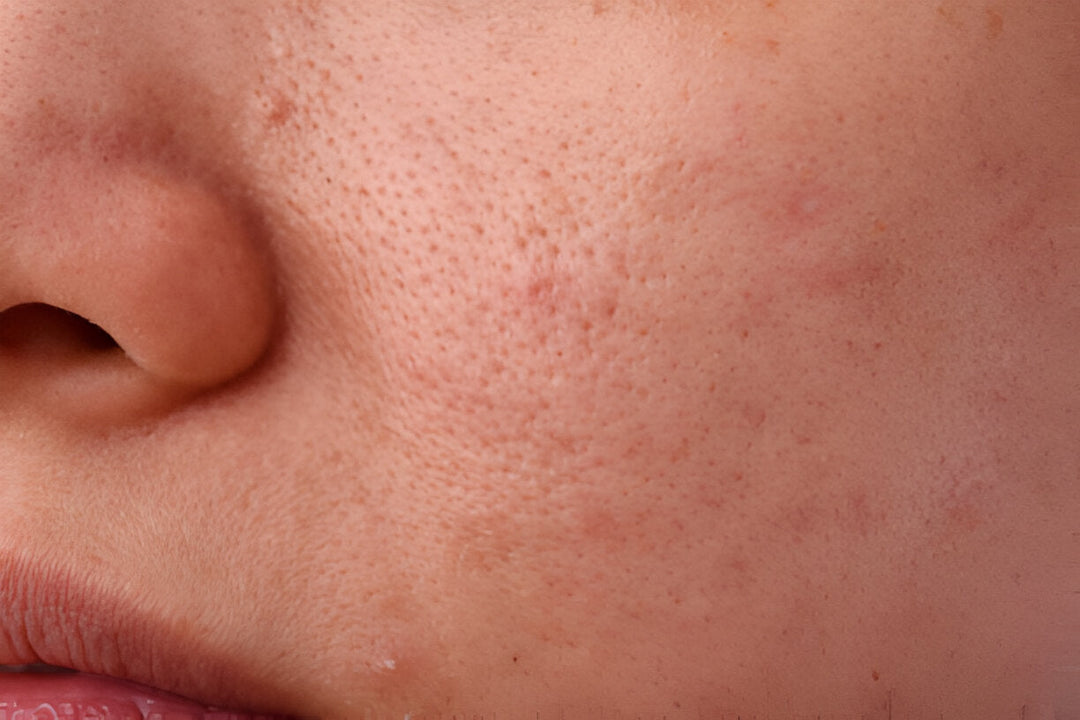 Fettige Haut Pflegeprodukte | Wonder Skin Deutschland